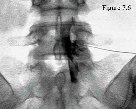 transforaminal epidural steroid injection