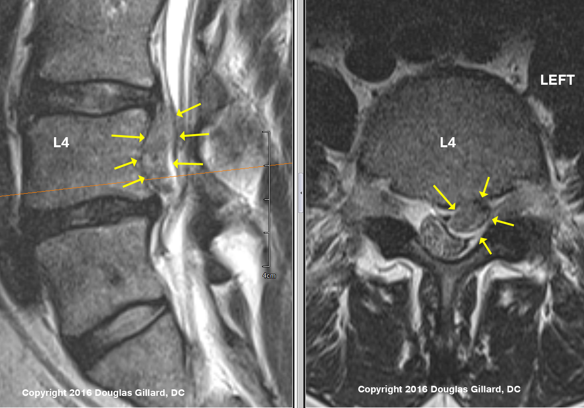 disc sequestration