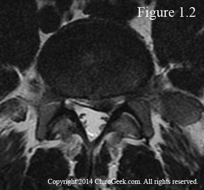 left paracentral disc herniation