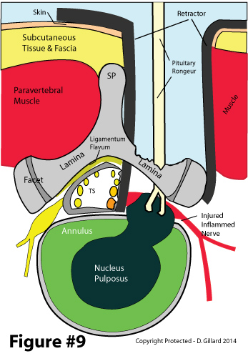 discectomy