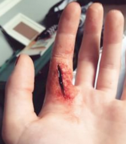 finger cut