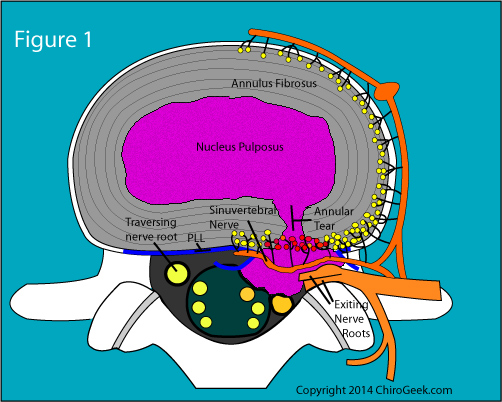 Disk herniation