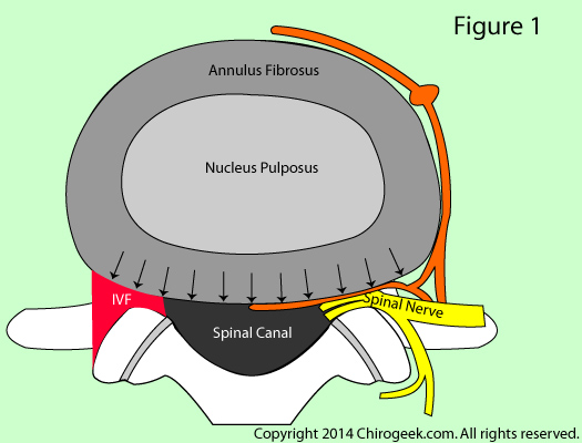 disc bulge