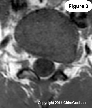 left extraforaminal disc herniation