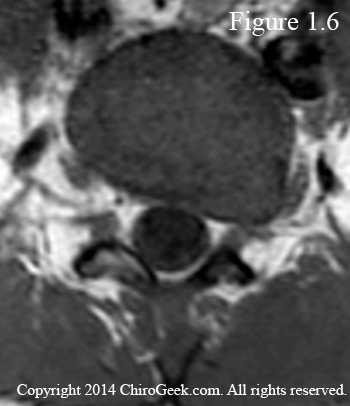 far lateral disc herniation