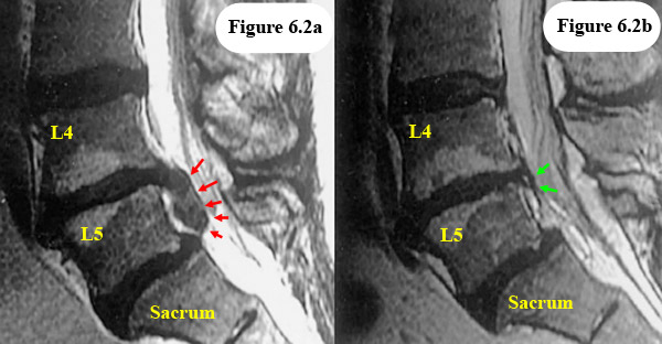 disc herniation resorption