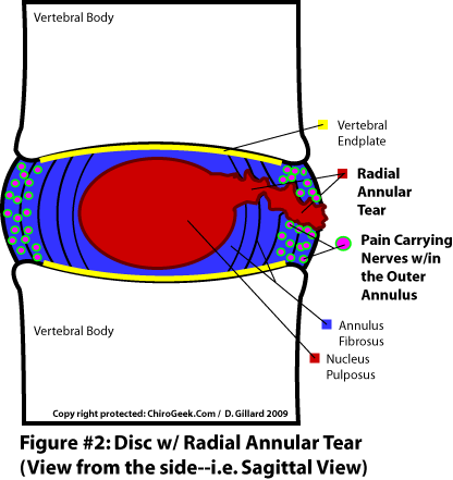 Annular Tears