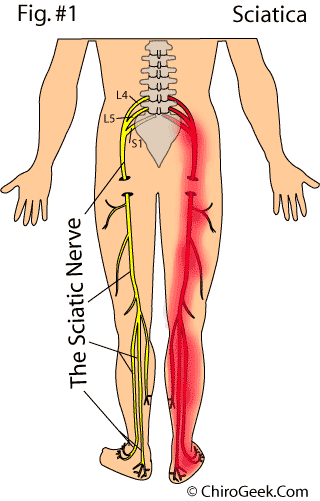 sciatica