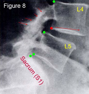 degenerative spondylolisthesis