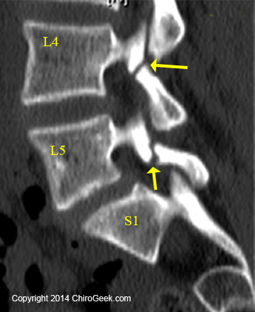 sagittal spondylolysis