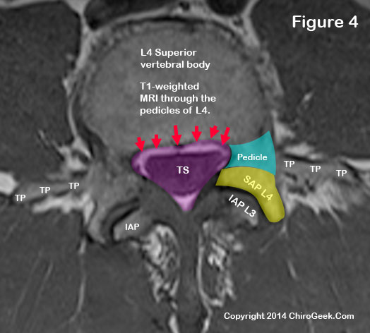 Central Stenosis