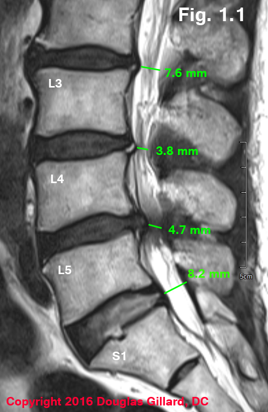 central stenosis-severe