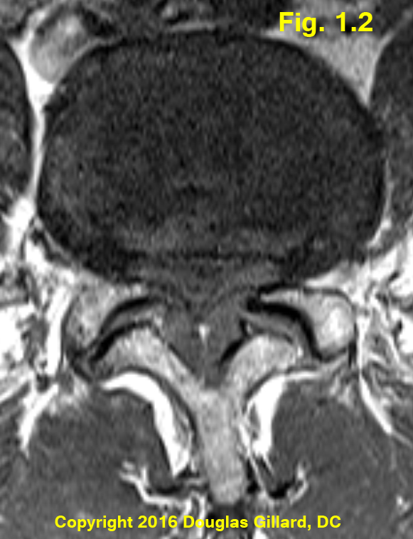 severe stenosis