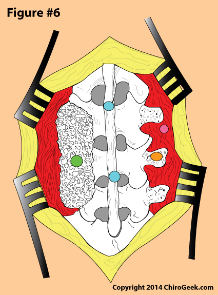  posterolateral fusion