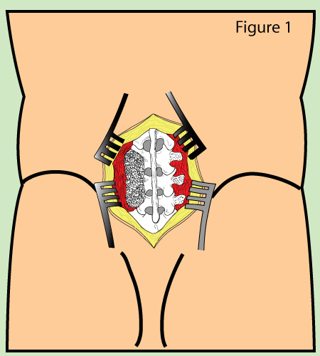 PLF fusion