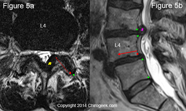 degenerative spondylolisthesis