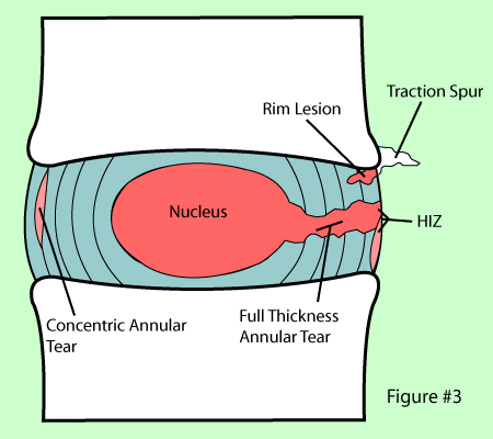 Annular Tears