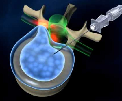 percutaneous discectomy